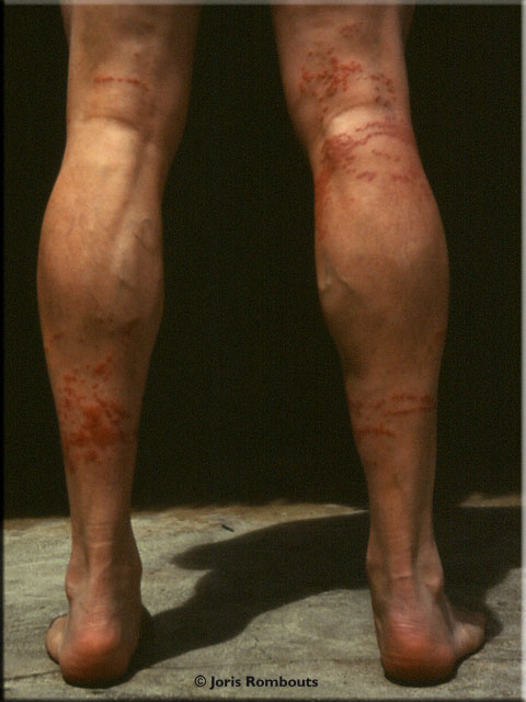 Jellyfish-Wounds